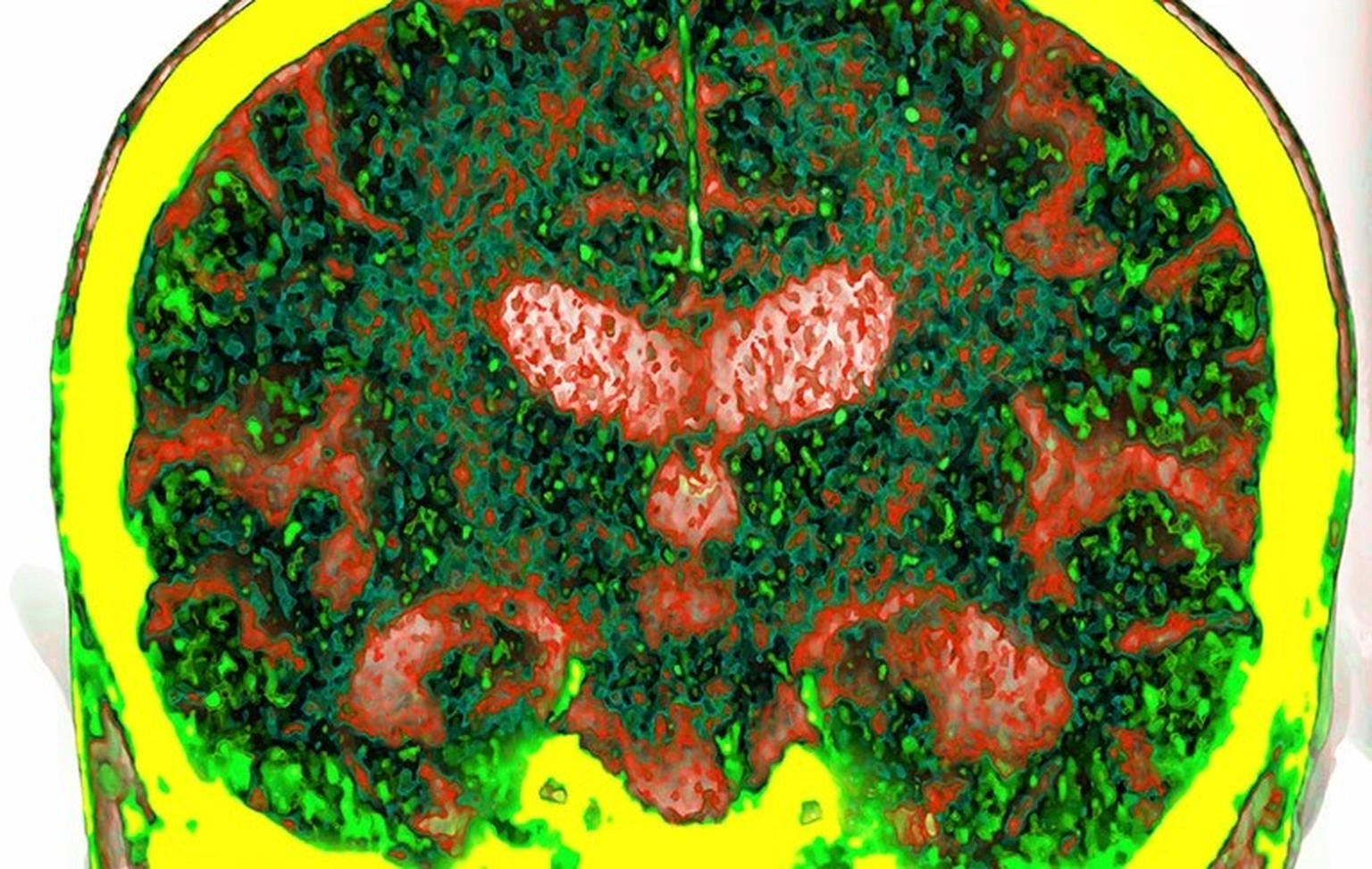 A computed-tomography scan of a brain affected by Alzheimer’s disease, the most common cause of dementia.