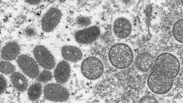 FILE - This 2003 electron microscope image made available by the Centers for Disease Control and Prevention shows mature, oval-shaped monkeypox virions, left, and spherical immature virions, right, ob ...