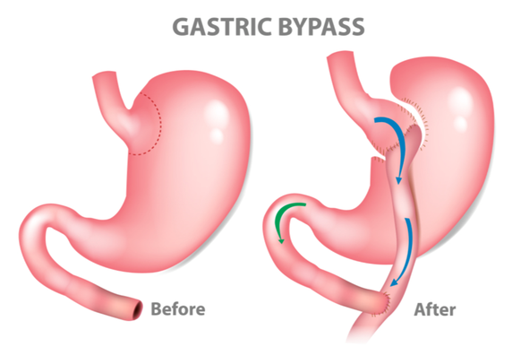 Magenbypass (gastric stapling) Grafik