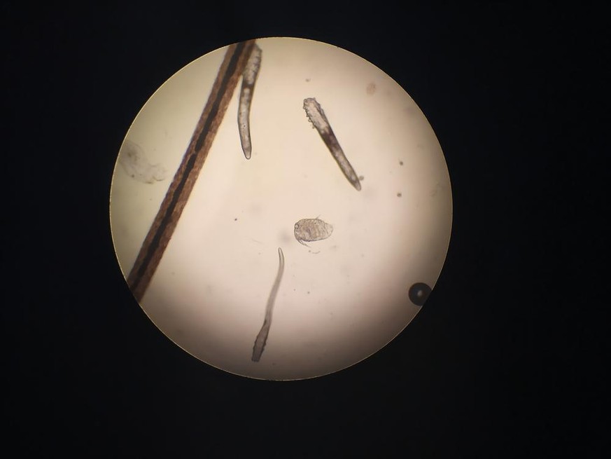 Haarbalgmilbenv (Demodex brevis und folliculorum)