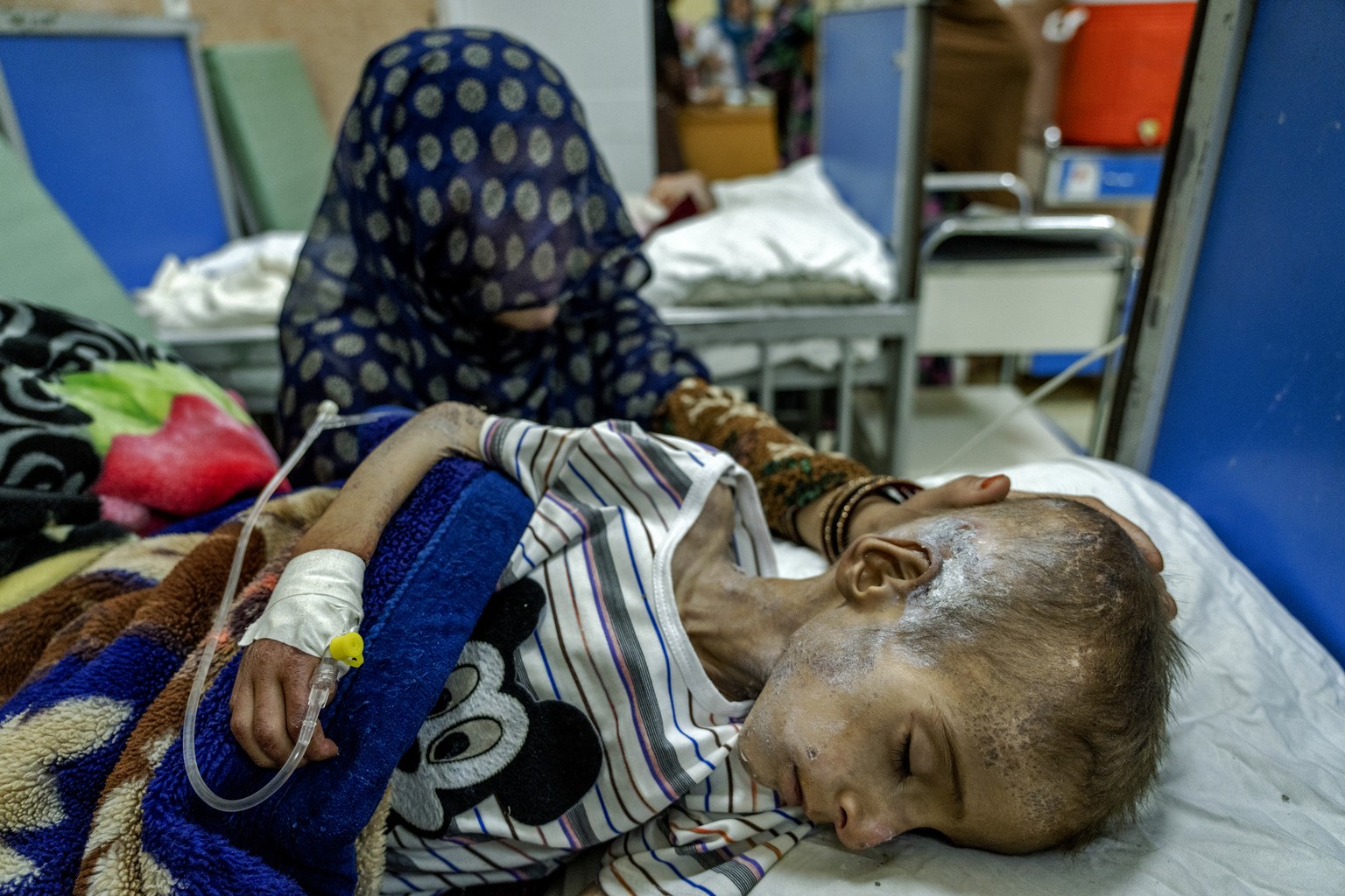 FILE - An Afghan mother helps her acutely malnourished boy at the Indira Gandhi Hospital in Kabul, Afghanistan, Sunday, May 22, 2022. Some 1.1 million Afghan children under five will face malnutrition ...