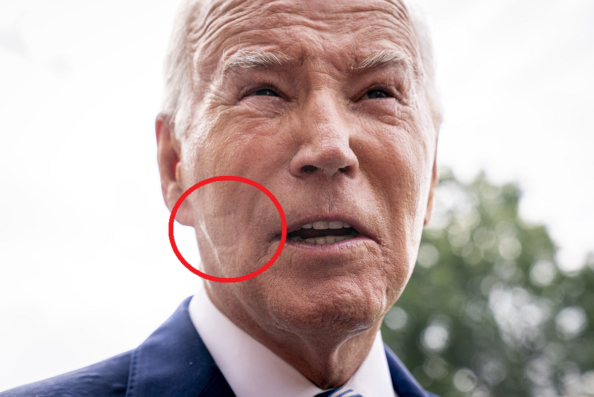 Joe Bident a des marques sur le visage.