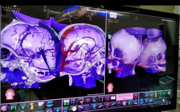 3d Modell der Köpfe der siamesischen Zwilligen