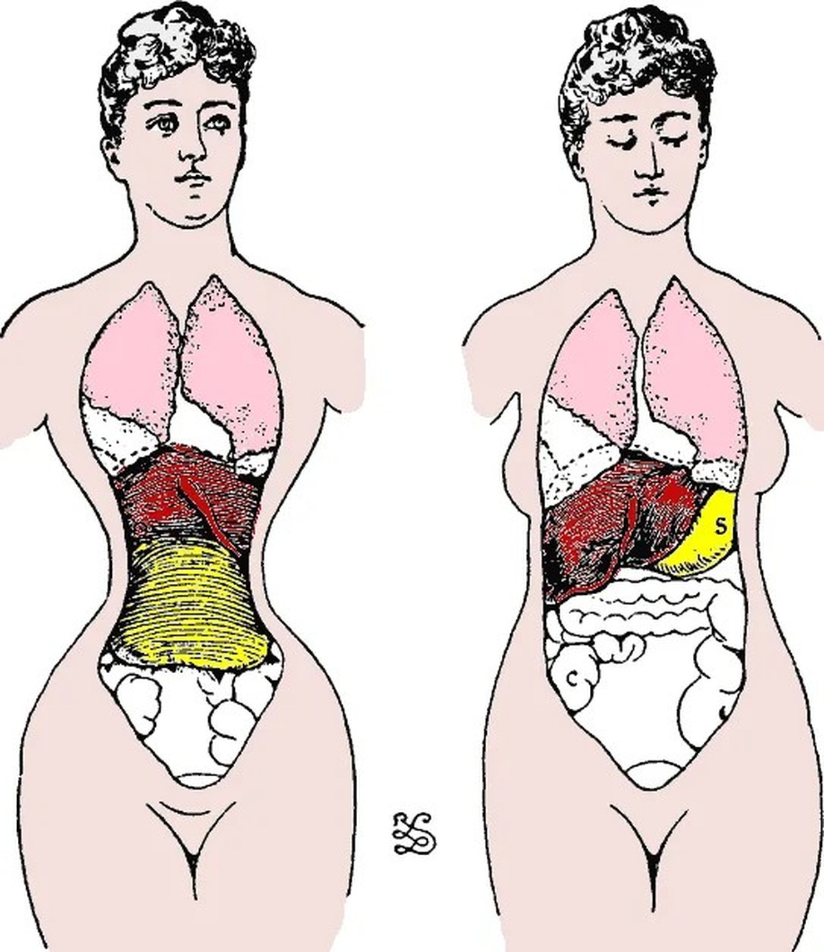 Die Medizin wies auf mögliche Organverlagerungen durch das Tragen eines Korsetts hin. Grafik aus dem Jahr 1887.
https://commons.wikimedia.org/wiki/File:Corset-normal_body.gif
