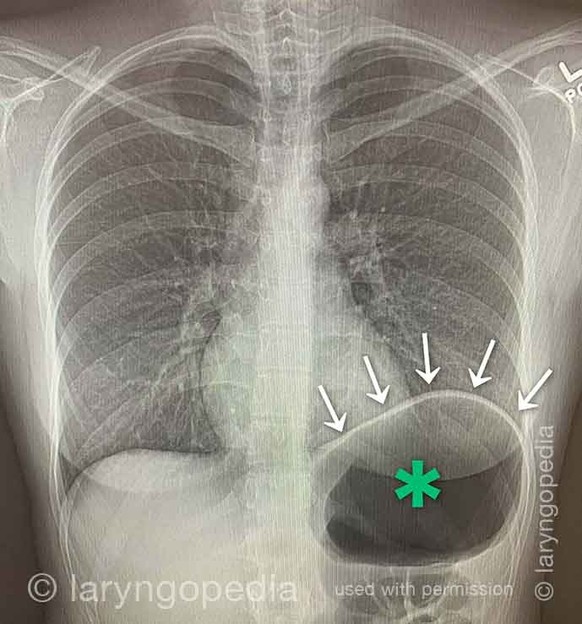 R-CPD retrograde cricopharyngeal dysfunction