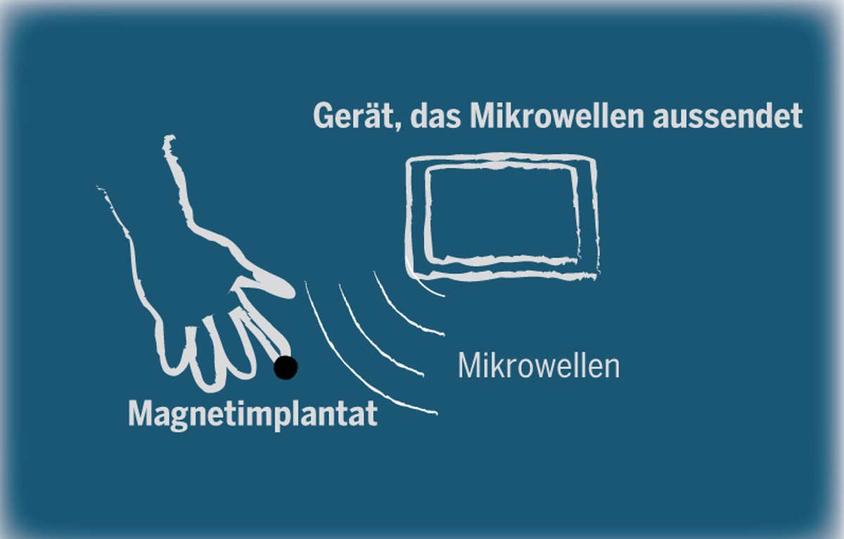 Dieses Implantat reiht sich in die Rubrik «Spielerei» ein. Gesunde Menschen lassen sich einen kleinen Magneten unter die Fingerkuppen implantieren, um ihre Wahrnehmung zu erweitern. Denn der Magnet im ...