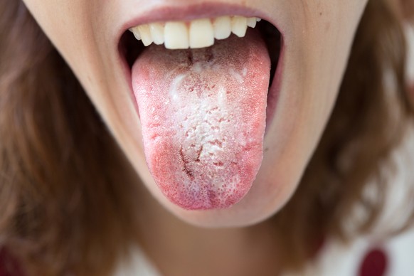 Candidose auf der Zunge. 