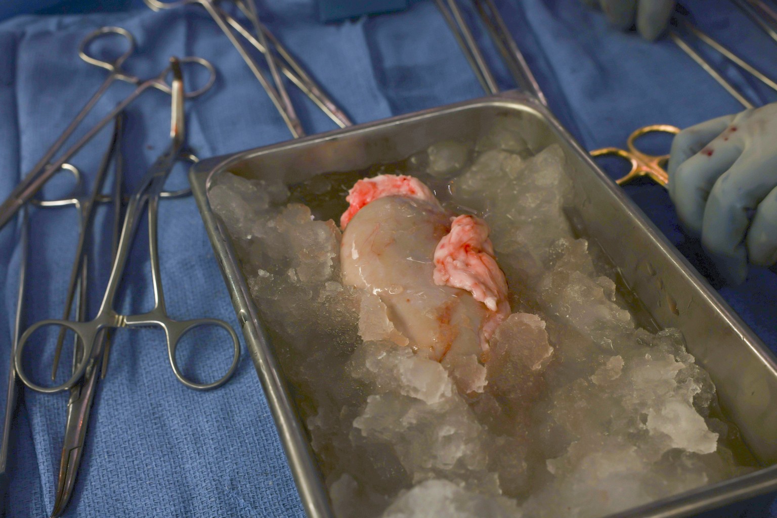 A pig kidney sits on ice, awaiting transplantation into a living human at Massachusetts General Hospital, Saturday, March 16, 2024, in Boston, Mass. (Massachusetts General Hospital via AP)