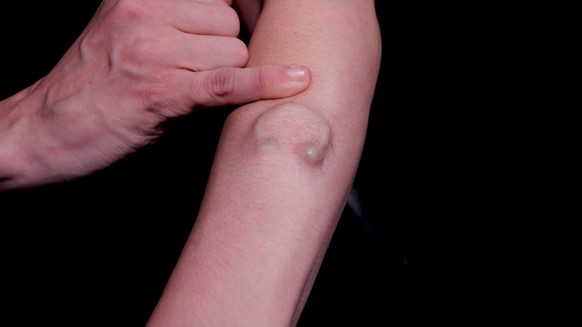 3D Implantat von Steve Void