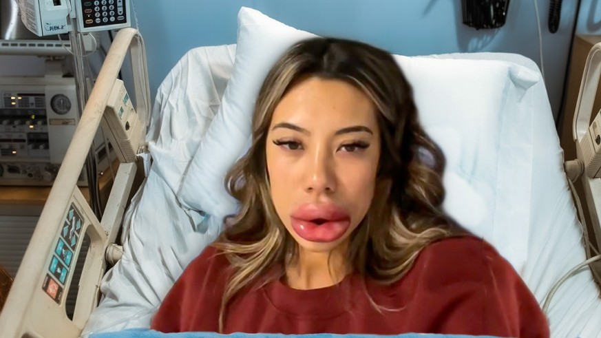 American woman injects lips – things are going very wrong Five percent of the Swiss population is vegetarian – and the number is increasing