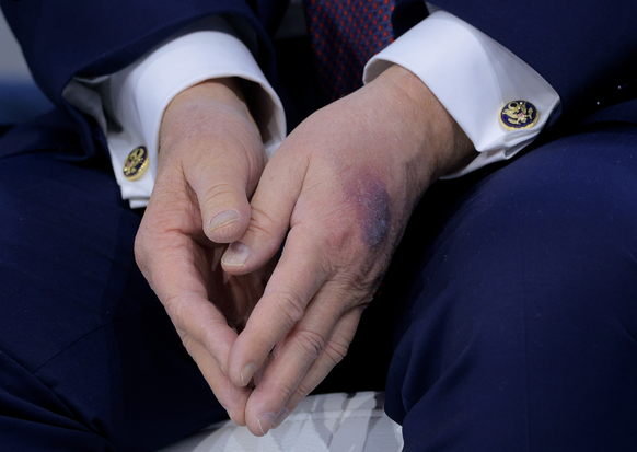 Donald Trump Bluterguss Hand WEF