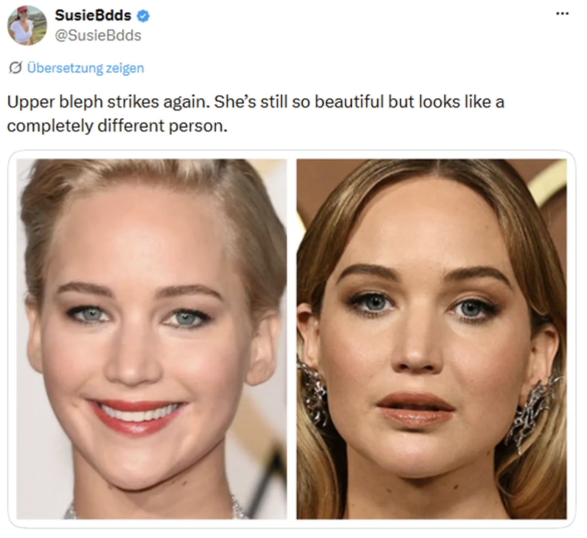Auf Social Media wird das «neue Gesicht» von Jennifer Lawrence mit Bildern von früher verglichen: «Sie sieht wie eine andere Person aus.»