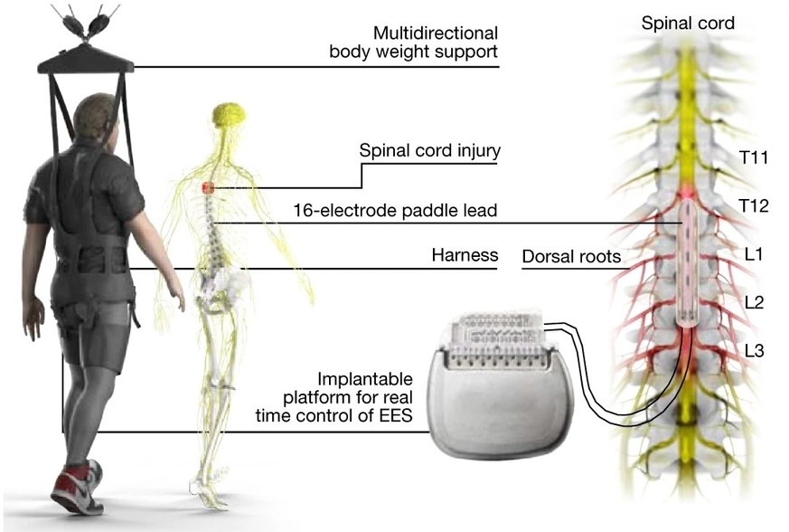 Body weight support system that allows walking on the floor and wireless, implantable pulse generator that operates in a closed circuit and uses a paddle electrode ...
