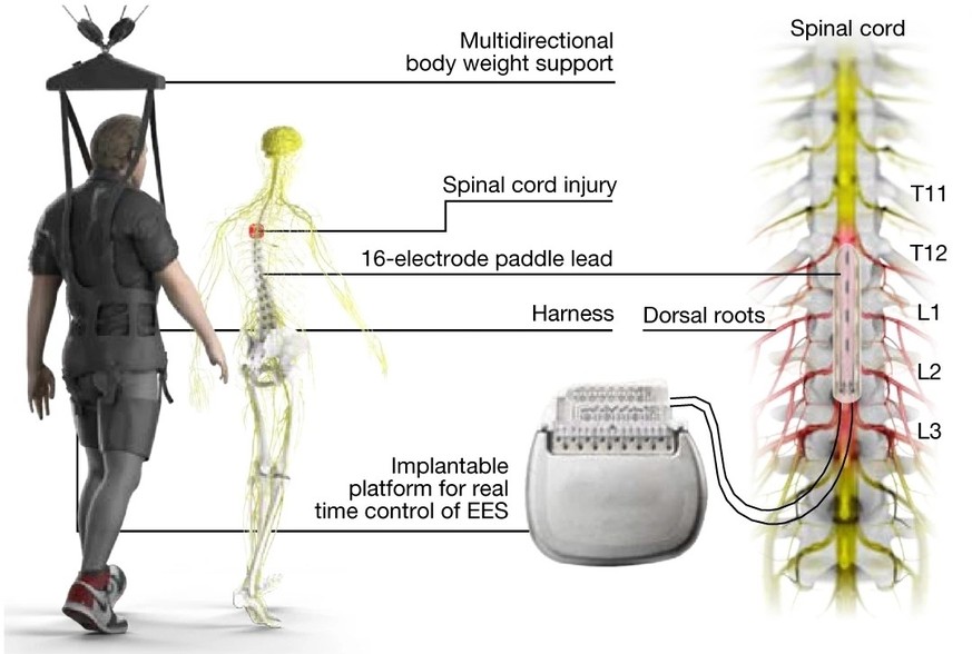 Körpergewichtsunterstützungssystem, das das Gehen auf dem Boden ermöglicht, und kabelloser, implantierbarer Impulsgenerator, der in einem geschlossenen Kreislauf arbeitet und mit einer Paddle-Elektrod ...