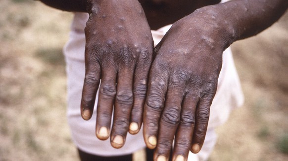 FILE - This 1997 image provided by the CDC during an investigation into an outbreak of monkeypox, which took place in the Democratic Republic of the Congo (DRC), formerly Zaire, and depicts the dorsal ...