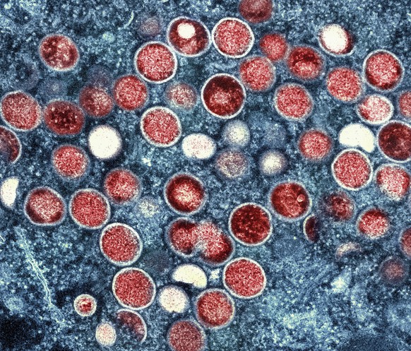 FILE - This image provided by the National Institute of Allergy and Infectious Diseases (NIAID) shows a colorized transmission electron micrograph of monkeypox particles (red) found within an infected ...