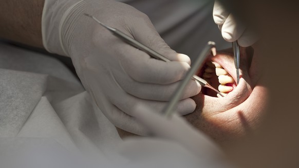 ZUM THEMA «RUECKVERGUETUNG VON ZAHNARZTKOSTEN» AM DONNERSTAG, 11. JANUAR 2018, STELLEN WIR IHNEN FOLGENDES BILDMATERIAL ZUR VERFUEGUNG --- Dentist Martin von Ziegler removes tartar from a patient&#039 ...