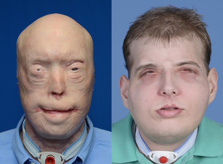 This combination of photos provided by the New York University Langone Medical Center shows Patrick Hardison before and after his facial transplant surgery in New York. Hardison was burned Sept. 5, 20 ...