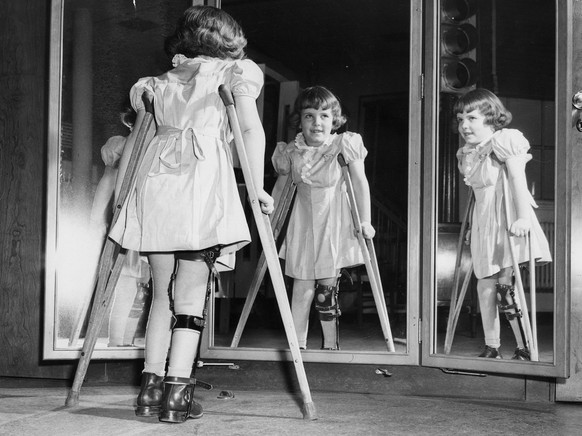 Many people infected with polio don&#039;t show any symptoms. Some become temporarily paralyzed; for others, it&#039;s permanent. In 1952, the polio epidemic reached a peak in U.S.: almost 58,000 repo ...