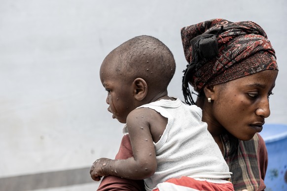 epa11582902 Francoise Bulangalire, 19, holds her 12-month-old son Michael Ombeni, who is being treated for Mpox, at the Kavumu hospital in Karanrhada, Kamavu, South Kivu province, Democratic Republic  ...