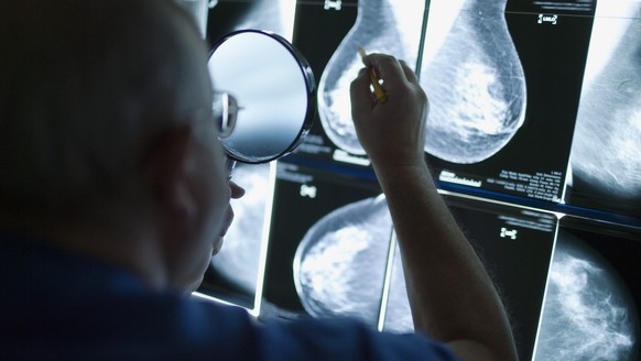 A radiologist looks at x-rays of a woman&#039;s breast at the Clinic Engeried in Bern, Switzerland, pictured on December 8, 2009. Mammography is a method for early detection of breast cancer (breast c ...
