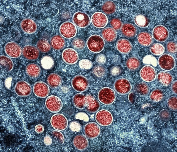 FILE - This undated image provided by the National Institute of Allergy and Infectious Diseases shows a colorized transmission electron micrograph of monkeypox particles (red) found within an infected ...