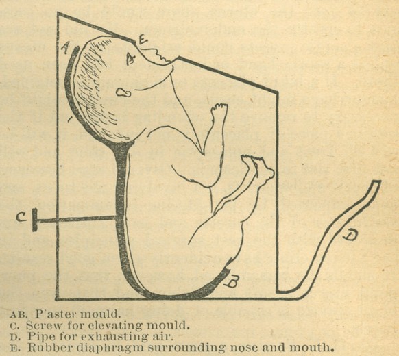 Dr. Egon Brauns Baby-Beatmungsgerät (1889).