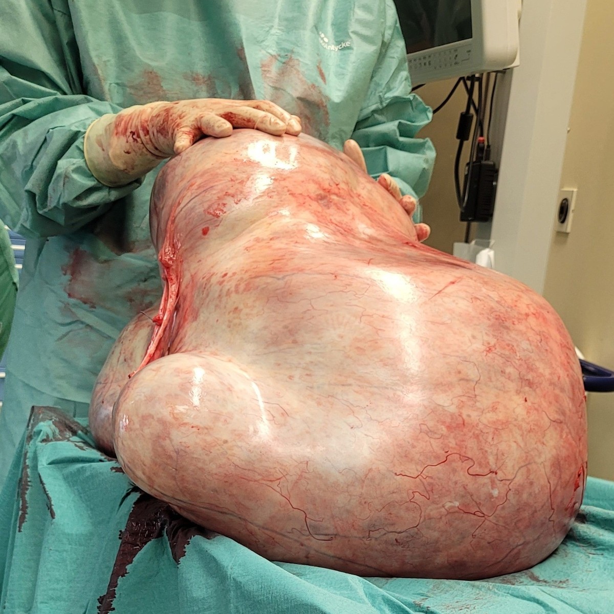 32 kg schwerer Eierstock-Tumor, Magdeburg