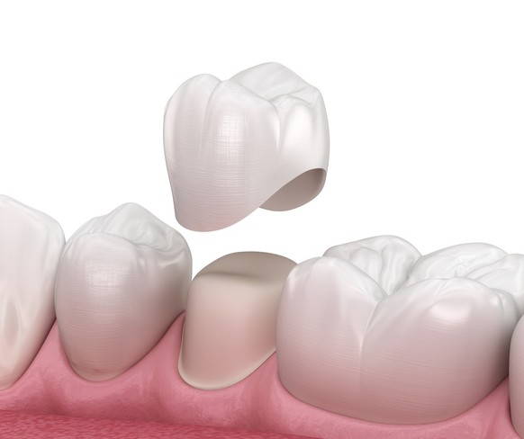 A dental crown is placed.