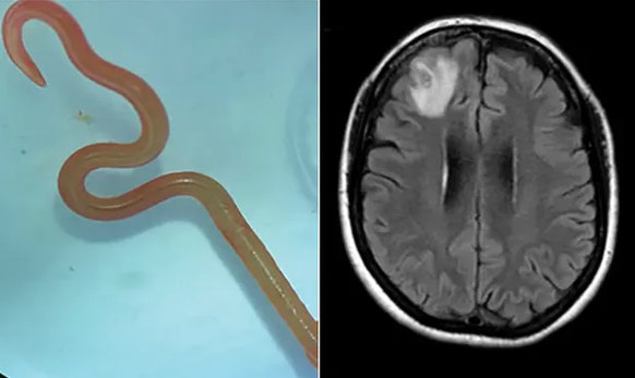 Das Exemplar der Ophidascaris robertsi-Larve, das von Chirurgen im Krankenhaus von Canberra lebend aus dem Gehirn der Frau entnommen wurde