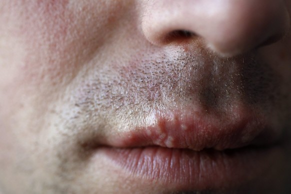 If there are blisters on the lips, this is called herpes labialis.