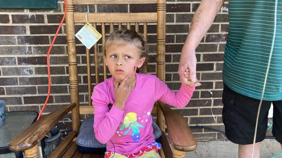 Syndication: Gaston Gazette Kinsley White, 6, shows reporters the wound left by a bullet in her face.  Kinsley White Gastonia NC , EDITORIAL USE ONLY PUBLICATIONxINxGERxSUIxAUTxONLY Copyright: xKaraxFohne ...