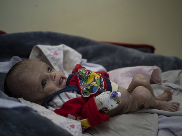 Mohammed, 4 years old, who is malnourished, lays on a hospital bed in the Indira Gandhi hospital in Kabul, Afghanistan on Monday, Nov. 8, 2021. The number of people living in Afghanistan in near-famin ...