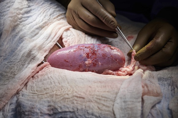 In this September 2021 photo provided by NYU Langone Health, a surgical team at the hospital in New York examines a pig kidney attached to the body of a deceased recipient for any signs of rejection.  ...