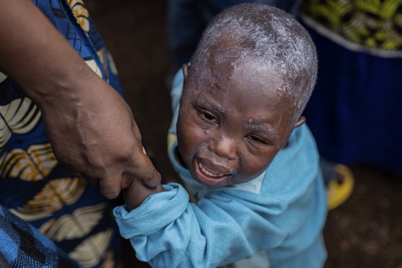 A child suffering from mpox receives treatment at a clinic in Munigi, eastern Congo, Friday, Aug. 16, 2024. (AP Photo/Moses Sawasawa)
