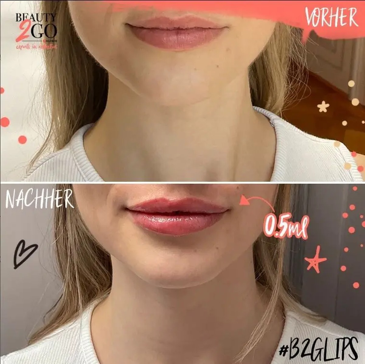 Sur les réseaux sociaux, Beauty 2 Go fait la promotion de lèvres pulpeuses grâce à des injections d'acide hyaluronique.