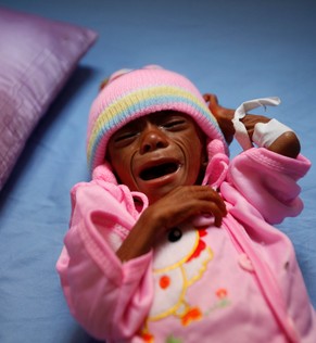 A malnourished boy lies on a bed at a malnutrition intensive care unit in the Red Sea port city of Houdeidah, Yemen November 17, 2016. Picture taken November 17, 2016. To match EXCLUSIVE YEMEN-FOOD/ R ...