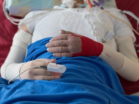 Eine brandverletzte Person liegt auf der Intensivstation.