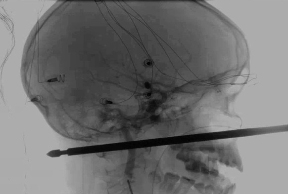 This X-ray provided by the Medical News Network shows a meat skewer impaled in the skull of Xavier Cunningham after an accident at his home Saturday, Sept. 8, 2018, in Harrisonville, Mo. Cunningham&#0 ...