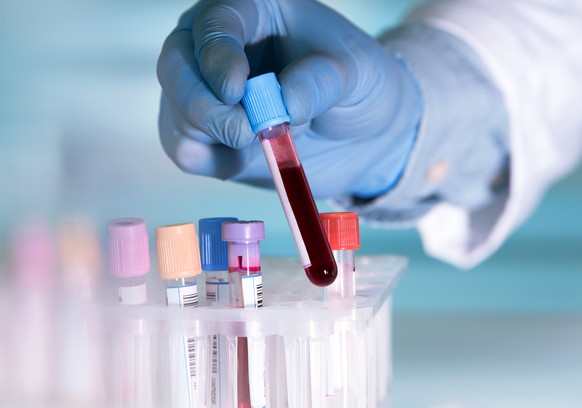 Krebs mit einem Bluttest früh erkennen zu können, könnte bald Wirklichkeit werden.
