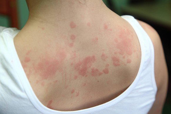 allergic dermatitis. The skin of the girl s back is amazed by dermatitis 1053_RF_04_28574328