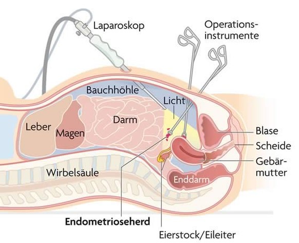 Bei der Bauchspiegelung führen Ärzte eine Kamera in die Bauchhöhle ein.