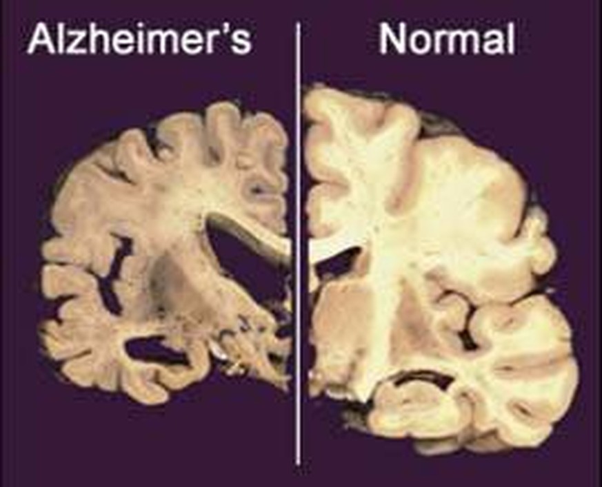 FILE - This undated file combo image provided by Merck &amp; Co., shows a cross section of a normal brain, right, and one of a brain damaged by advanced Alzheimer&#039;s disease. Researchers said an e ...