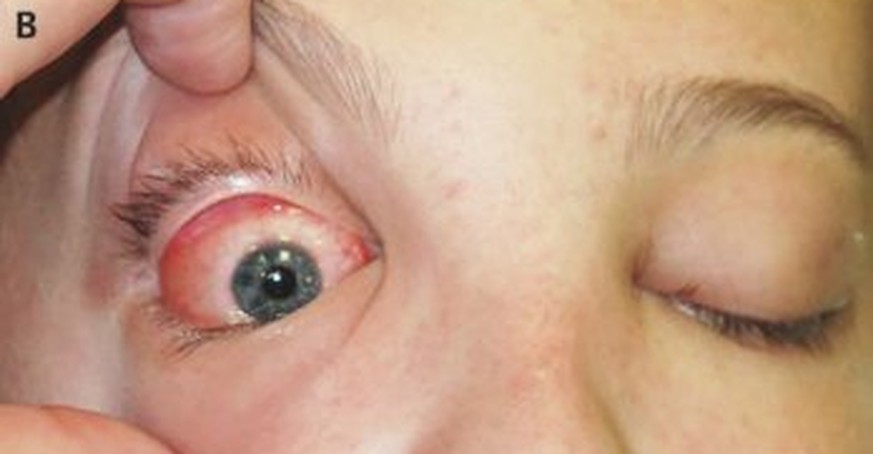 Schwellung am Auge, Sicht gestört: Die Patientin leidet an einer Entzündung – aber welcher Art?