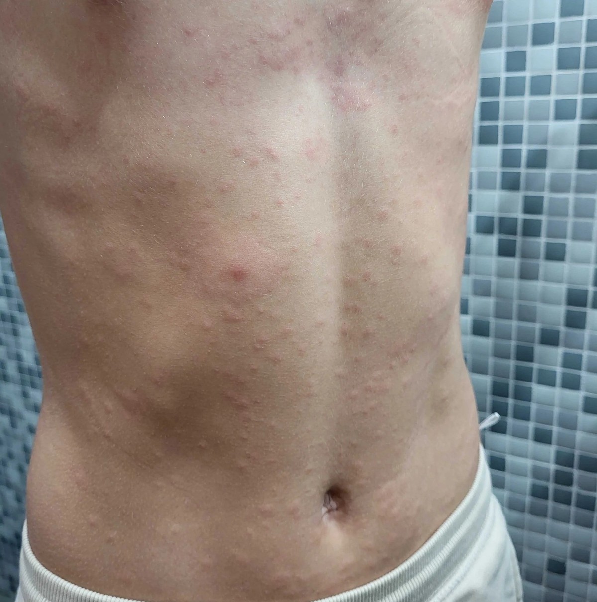 Le corps d'Enzo s'est couvert de petits boutons rouges après qu'il a mangé un hamburger.