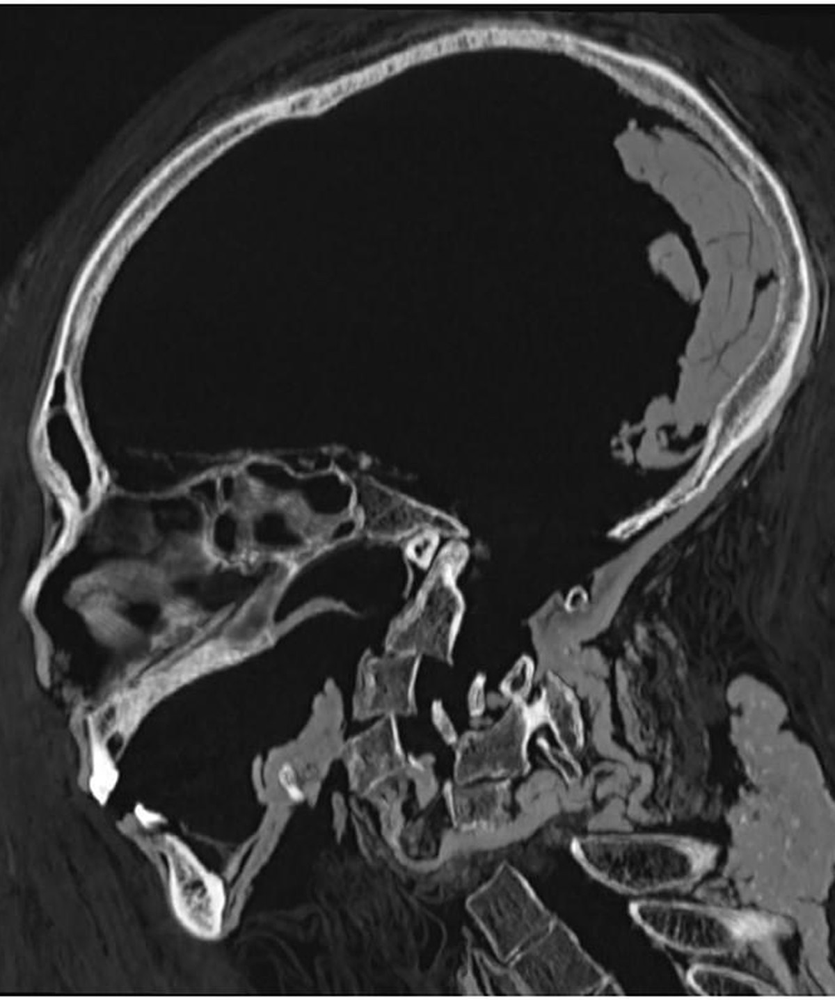 Mid-sagittal CT image of the head and neck of the mummy of Amenhotep I shows an intact cribriform plate and the preserved desiccated brain rests at the back of the skull. Fractured cervical spine with ...