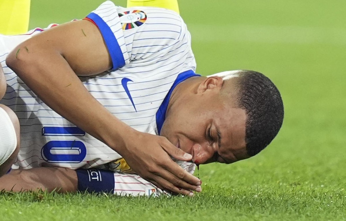DUSSELDORF, GERMANY - JUNE 17: (EDITOR'S NOTE: Image depicts graphic content) Kylian Mbappe (10) of France bleed from the nose during the 2024 European Football Championship (EURO 2024) Group D f ...