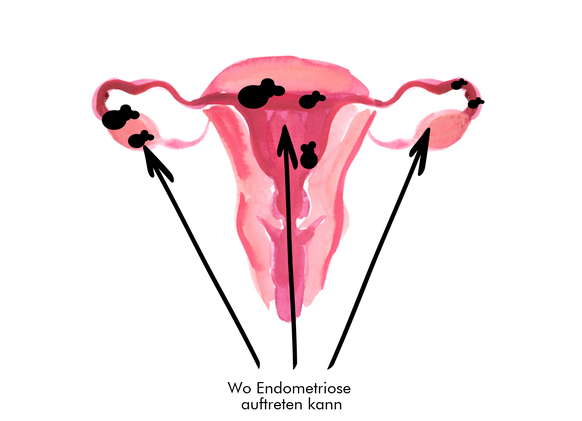 Endometriosenherde auf Bauchfell und im Eierstock.
