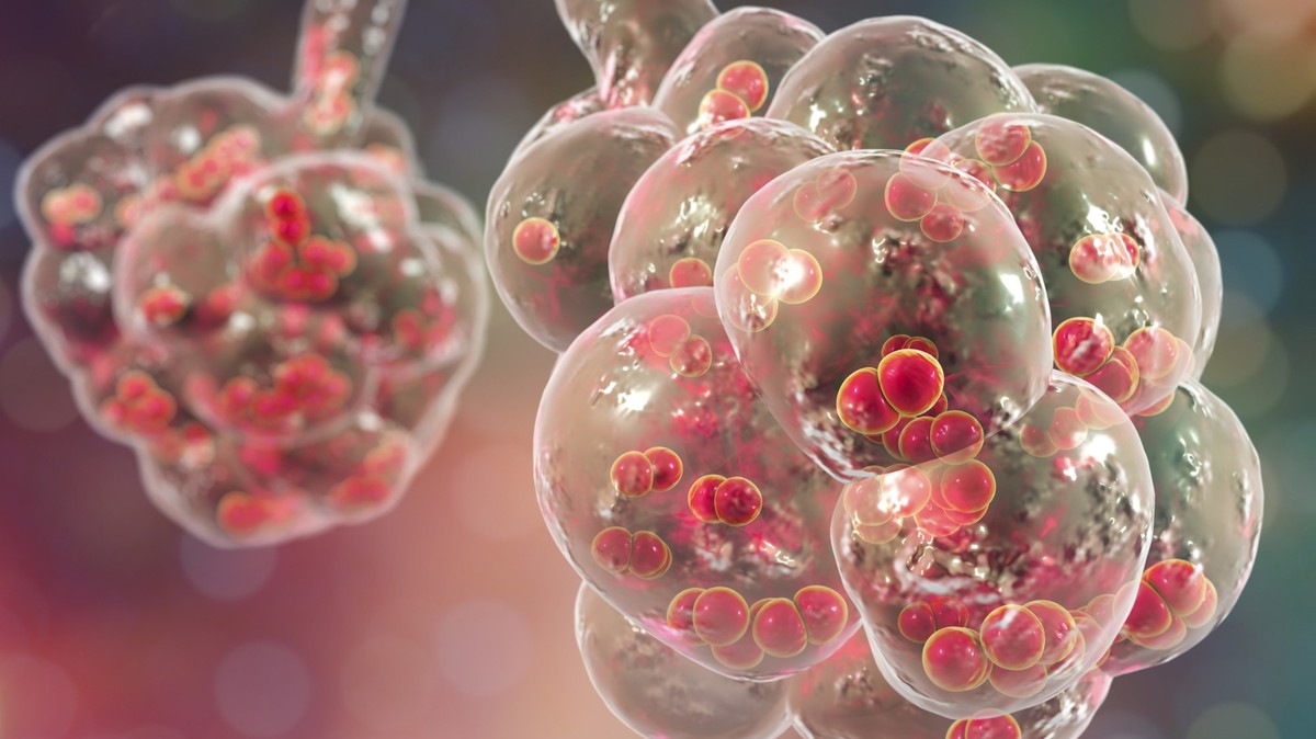 Pneumococcal pneumonia. Computer illustration of Streptococcus pneumoniae (pneumococci) bacteria inside the alveoli of the lungs, causing pneumonia.