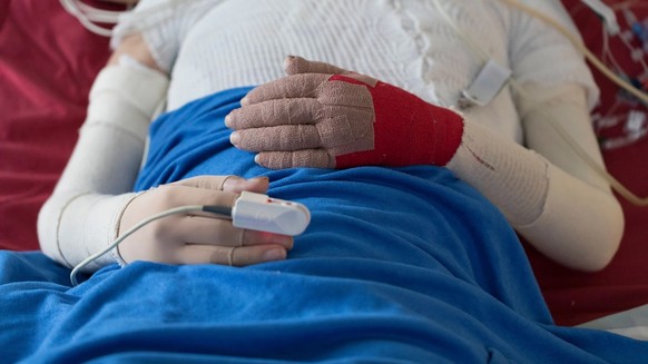 Eine brandverletzte Person liegt auf der Intensivstation.